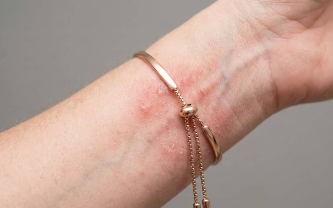 Metal Allergies & Jewelry Allergic Reactions