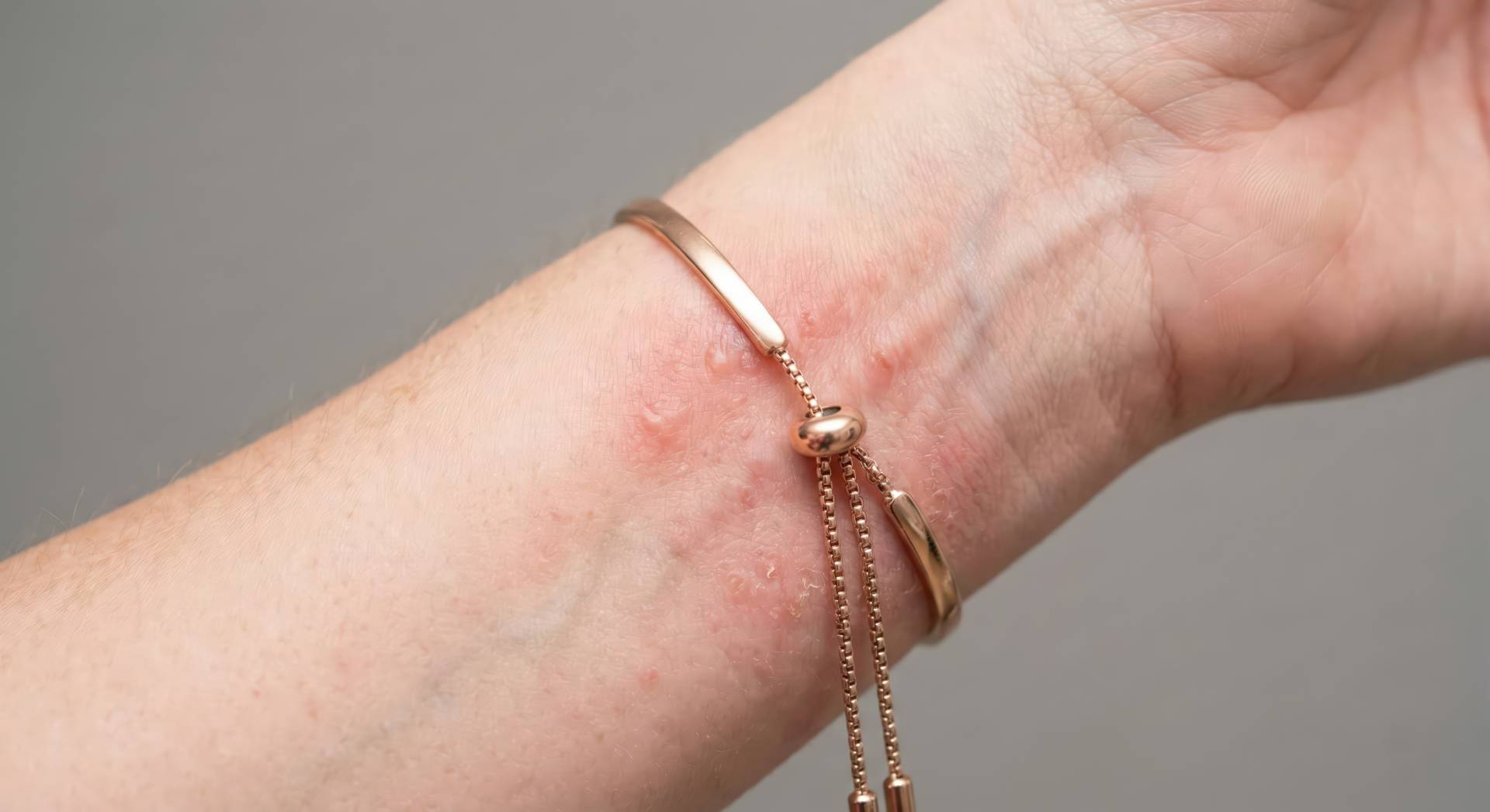 Metal Allergies & Jewelry Allergic Reactions Metal Allergies & Jewelry Allergic Reactions